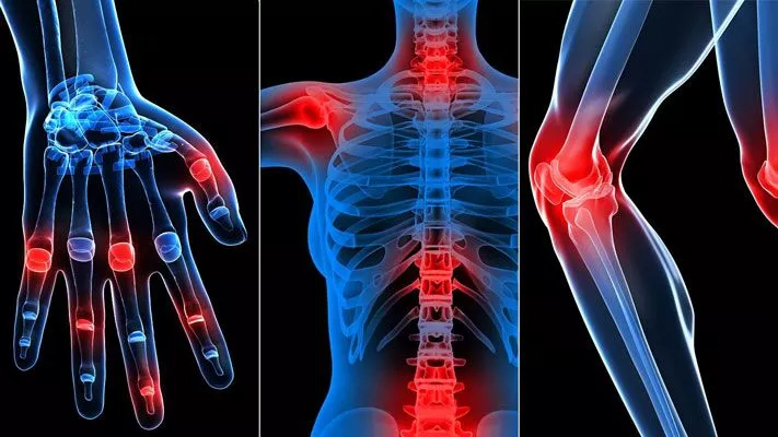 Rheumatic Diseases: Disorders of Joint and Connective Tissue